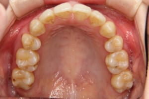 口蓋側にあった側切歯もきれいに並びました。